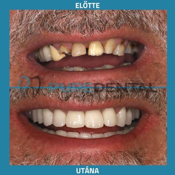 Fogimplantátum eredmények